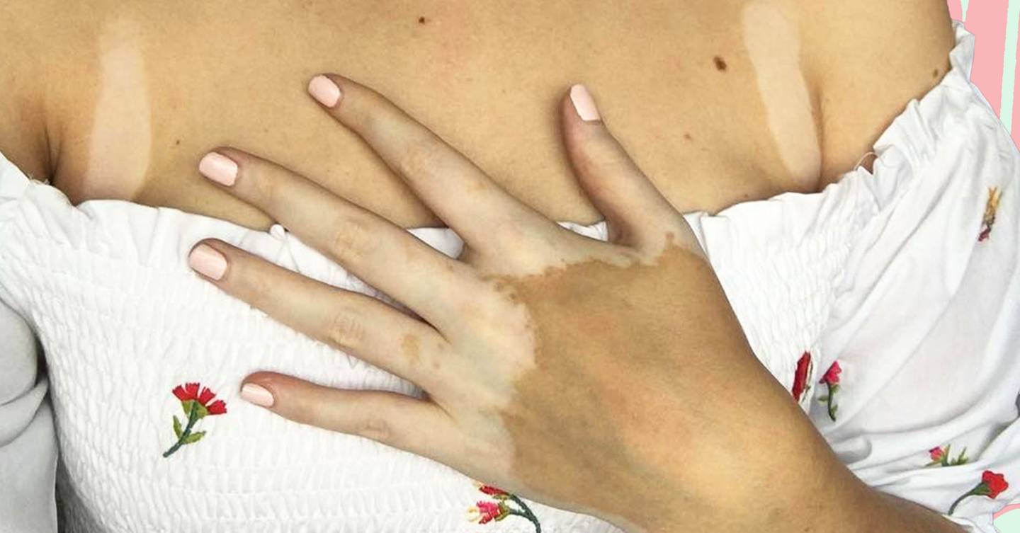 This World Vitiligo Day, I'm sharing my story of living with the condition almost my whole life – and what it's taught me about loving the skin I'm in 1 This World Vitiligo Day, I'm sharing my story of living with the condition almost my whole life – and what it's taught me about loving the skin I'm in