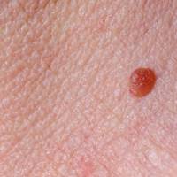 Your Fail-Safe Guide To Skin Tags From An Expert Dermatologist | Glamour UK