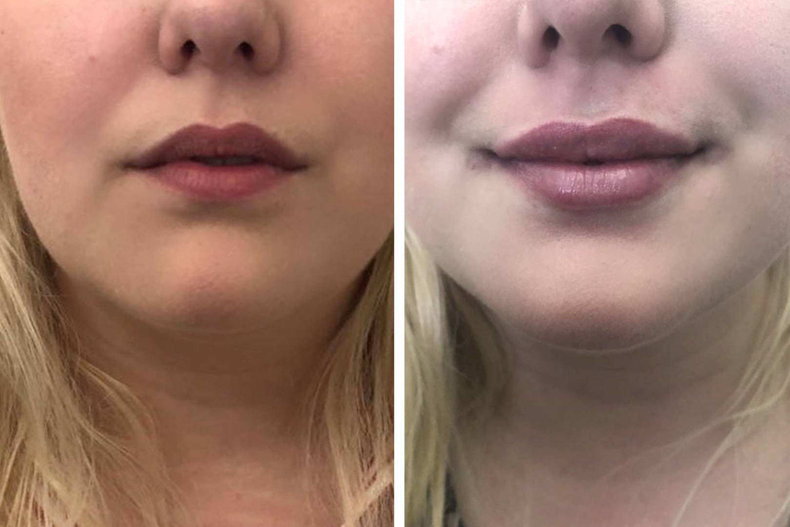 This Is How To Get Natural Looking Lip Fillers Glamour Uk