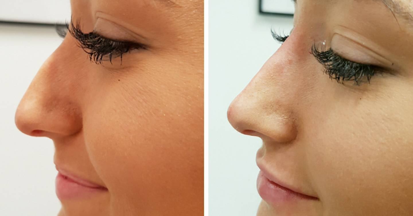 non-surgical-nose-job-everything-you-need-to-know-glamour-uk