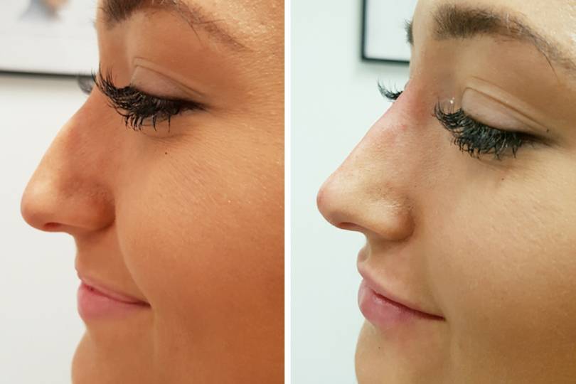 Non-Surgical Nose Job: Everything You Need To Know | Glamour UK