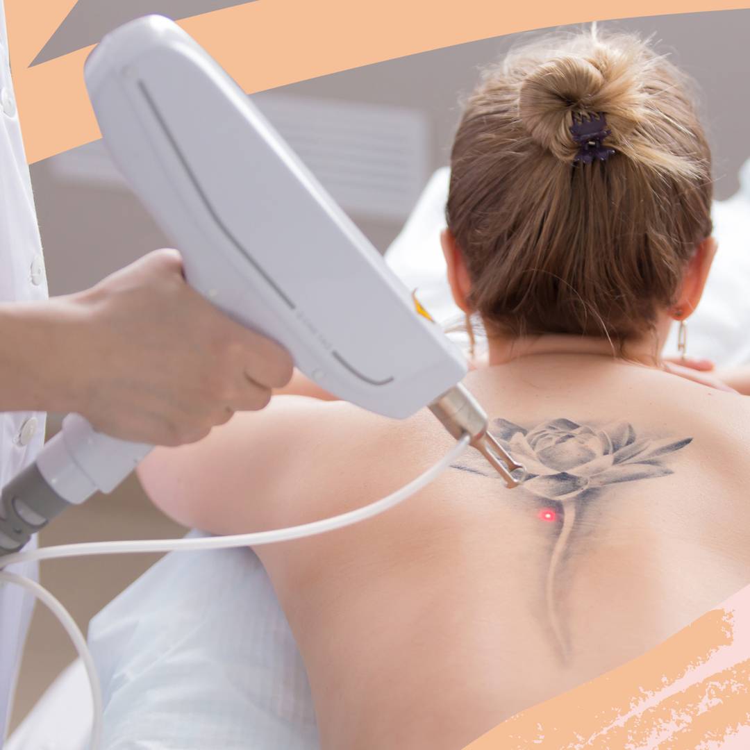 Image: Everything you need to know about tattoo removal (including how much it actually hurts)