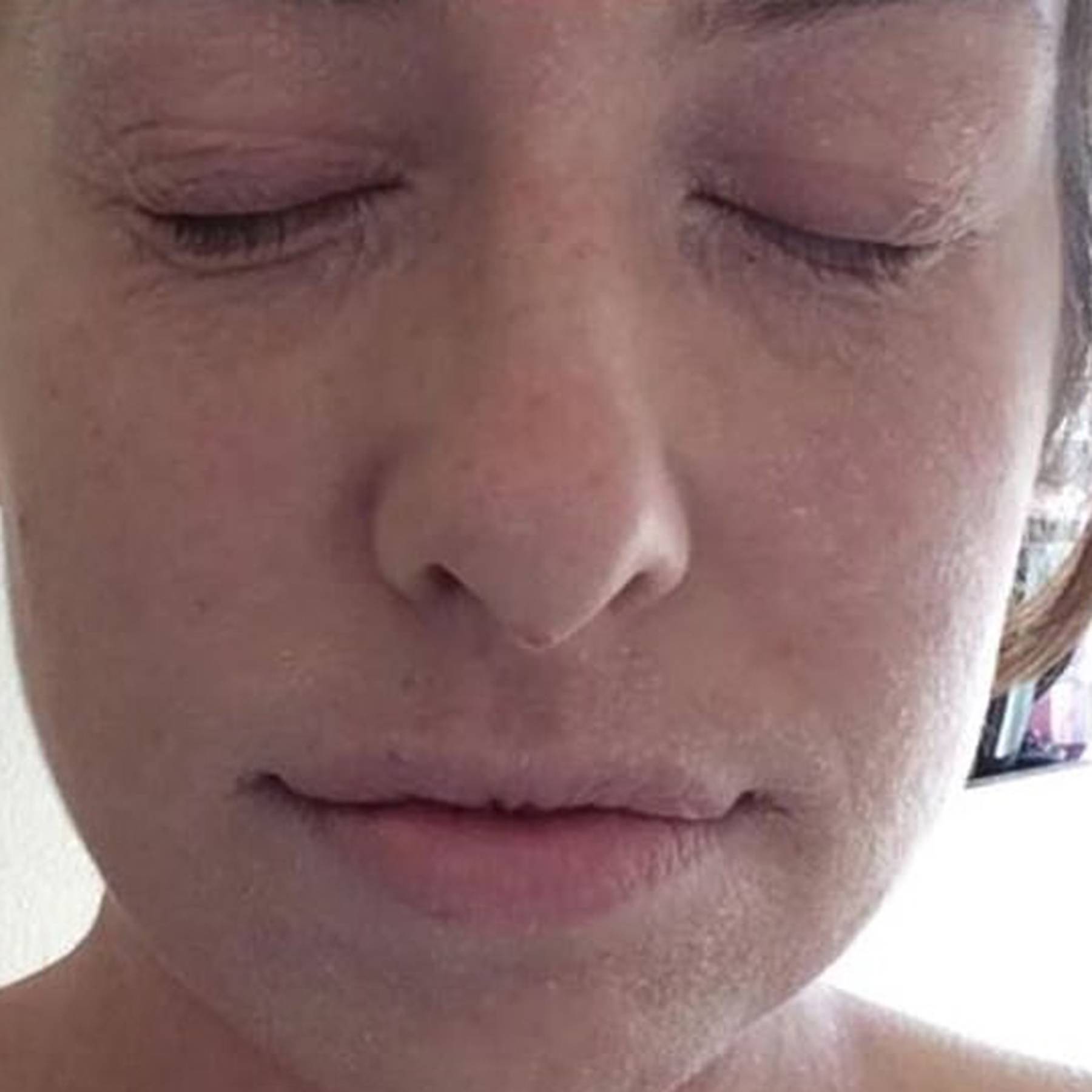 cerave moisturizing cream eczema reddit