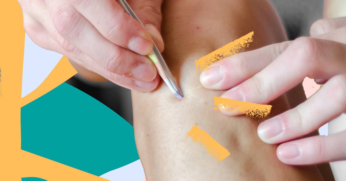 How To Remove An Ingrown Hair An Expert Guide To Prevention Glamour UK