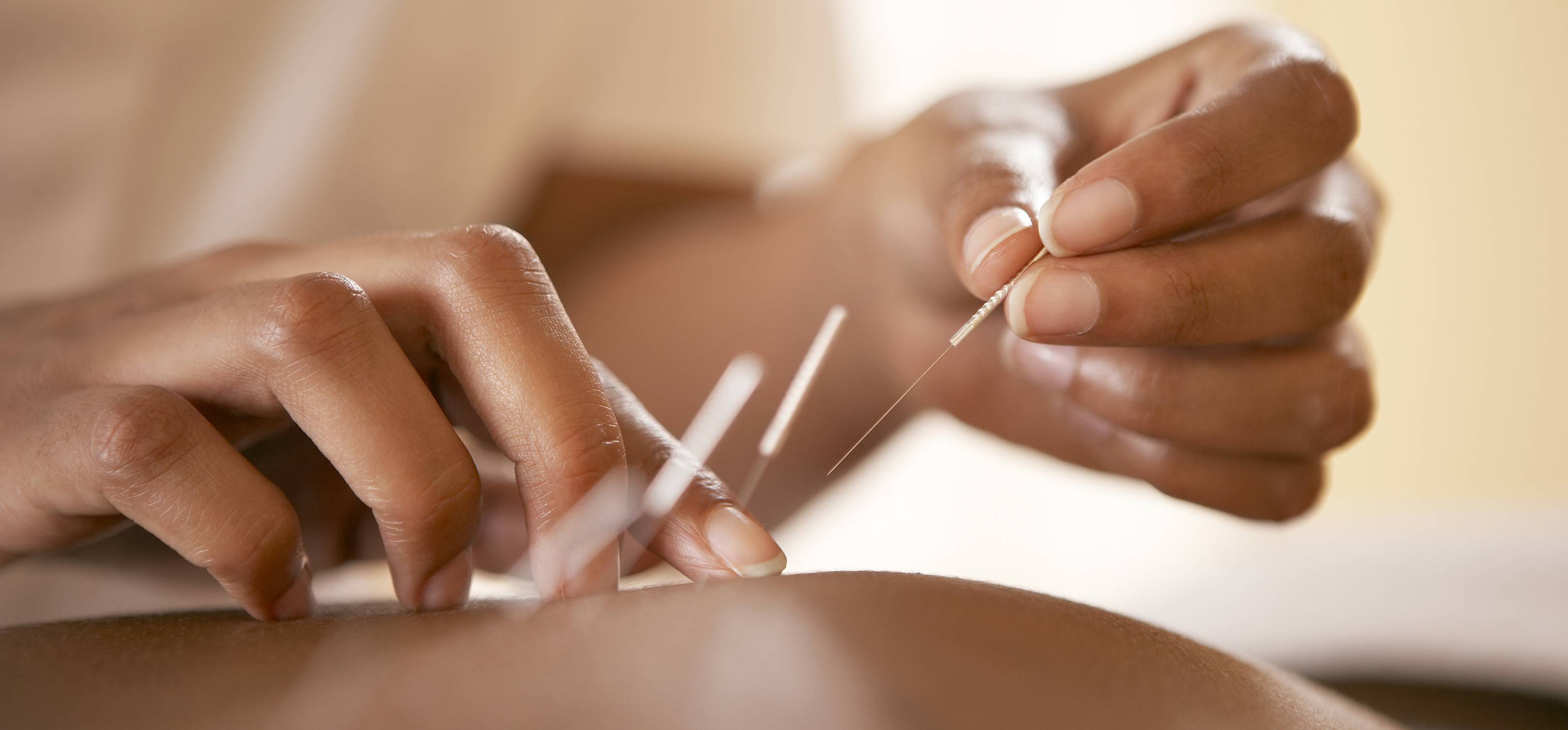 Acupuncture What It Is And Does It Work Glamour Uk