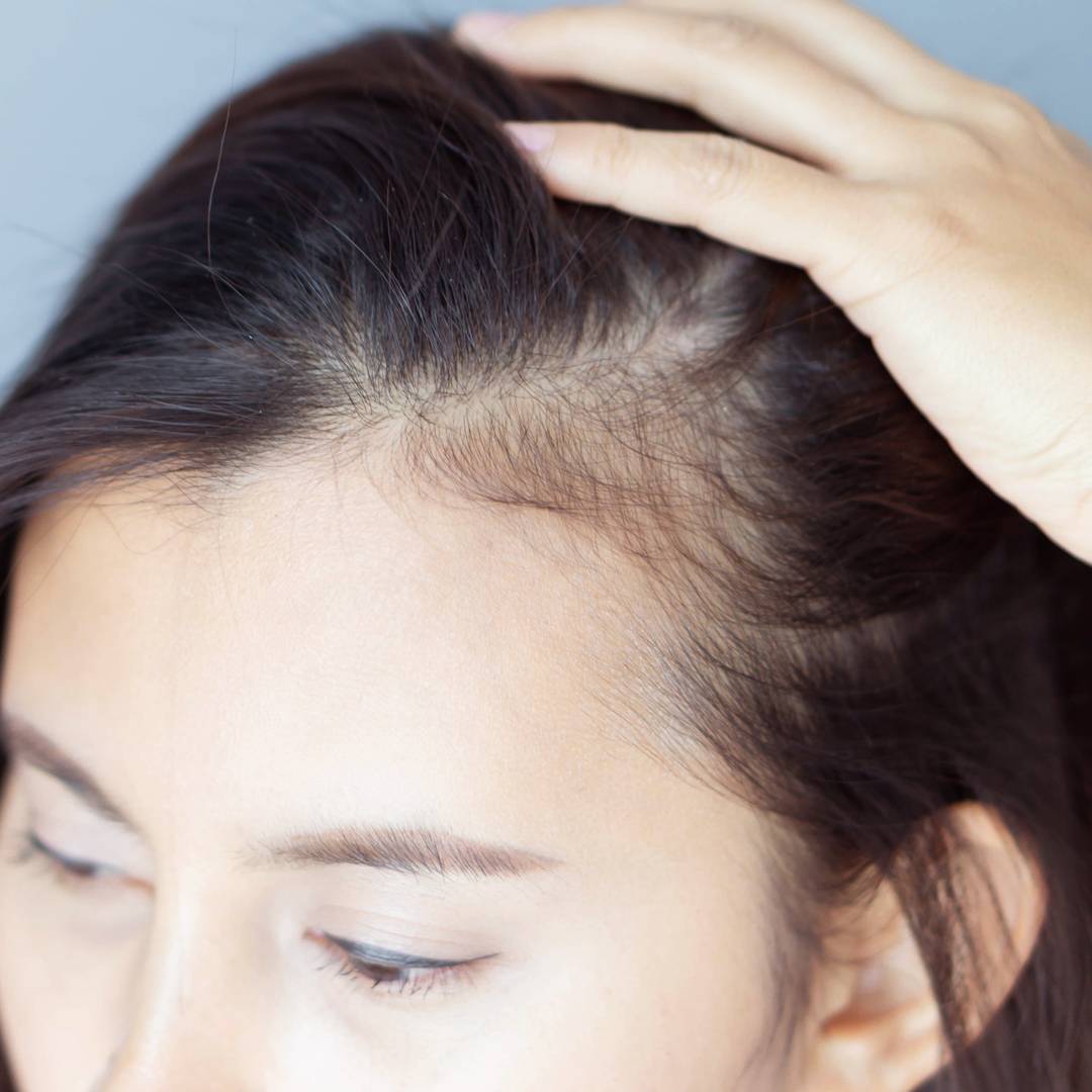 Image: Yes, you can get eczema on your scalp and here's how to deal with it