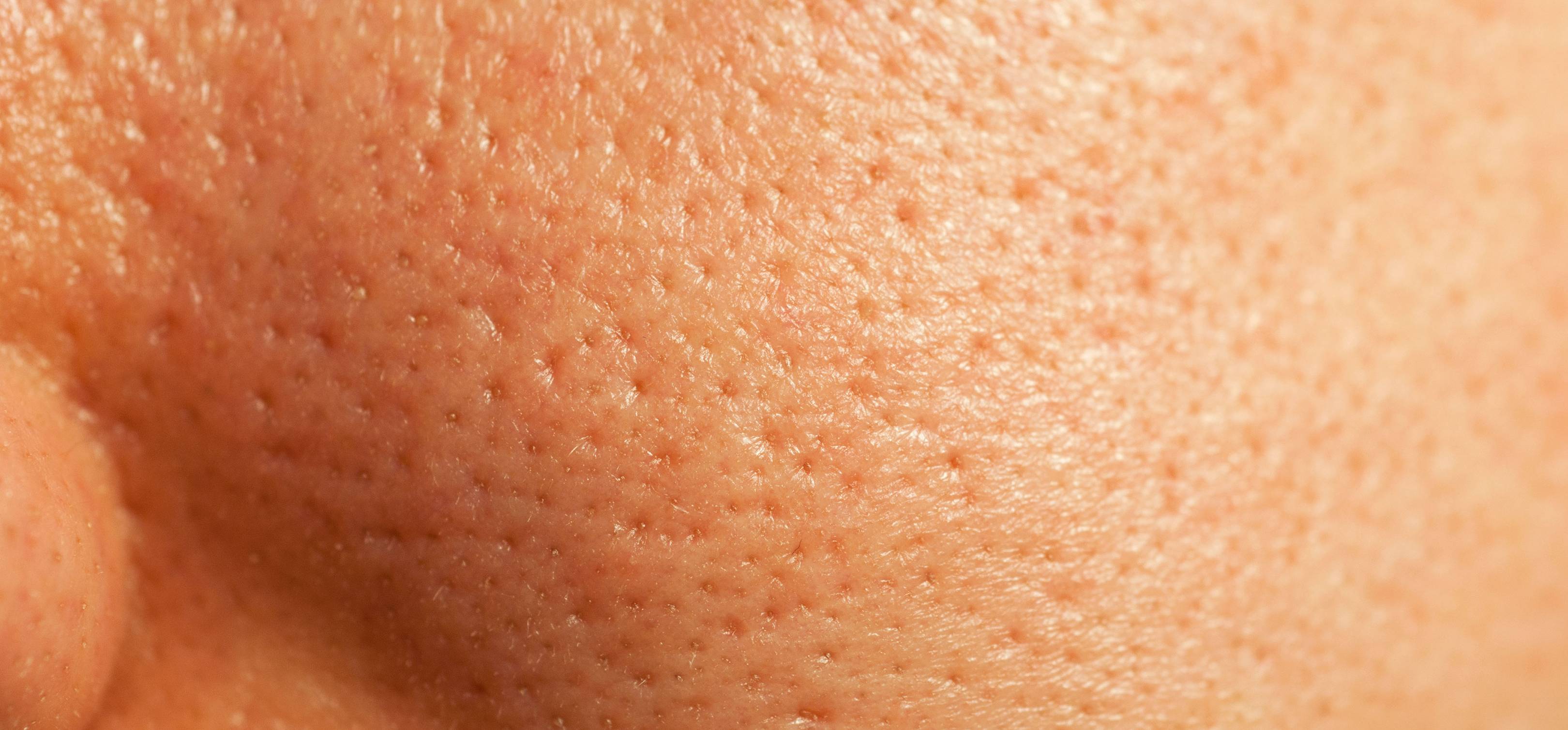 small pores on face