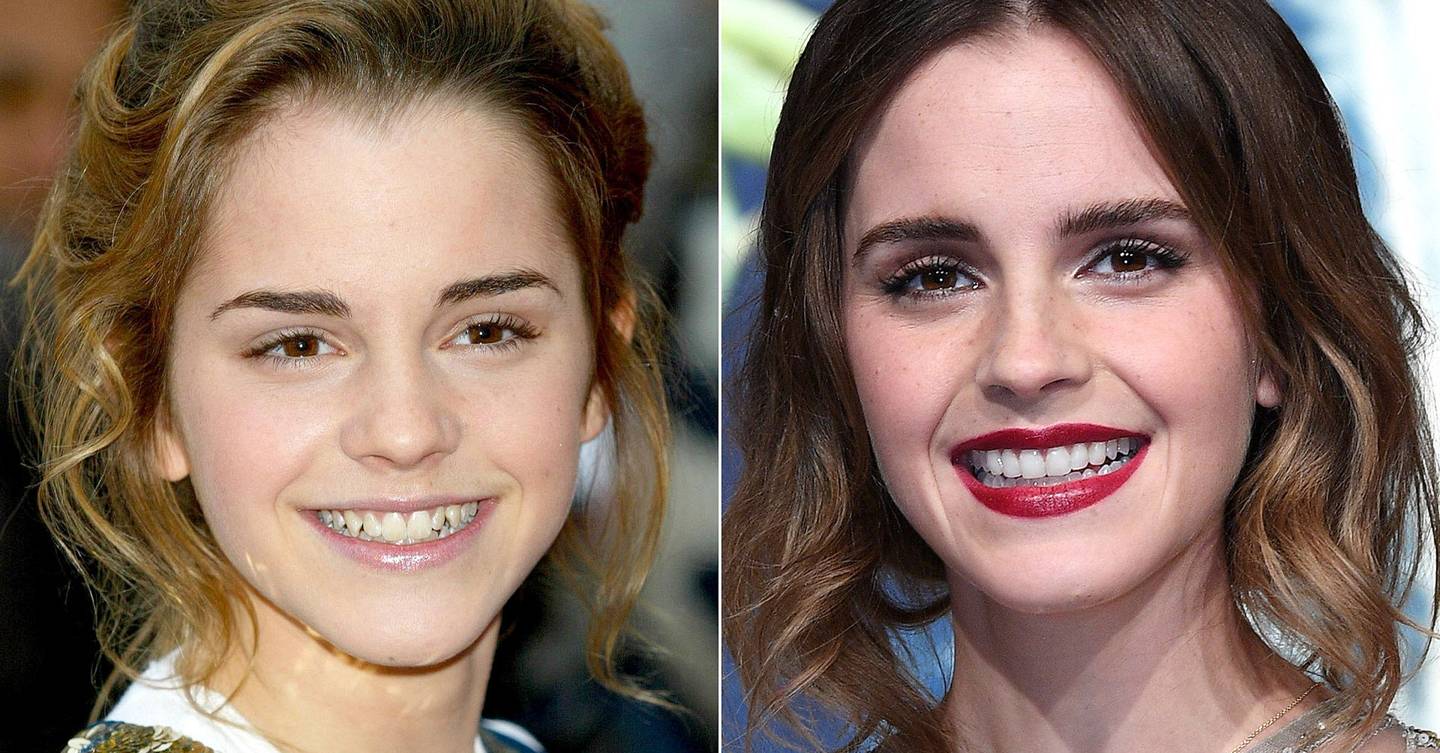 Celebrity Teeth Before & After Teeth Whitening Makeovers Pictures 2017 Glamour UK