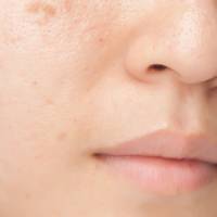 How To Get Rid Of Acne Scars: Expert Advice, Preventatives And Products