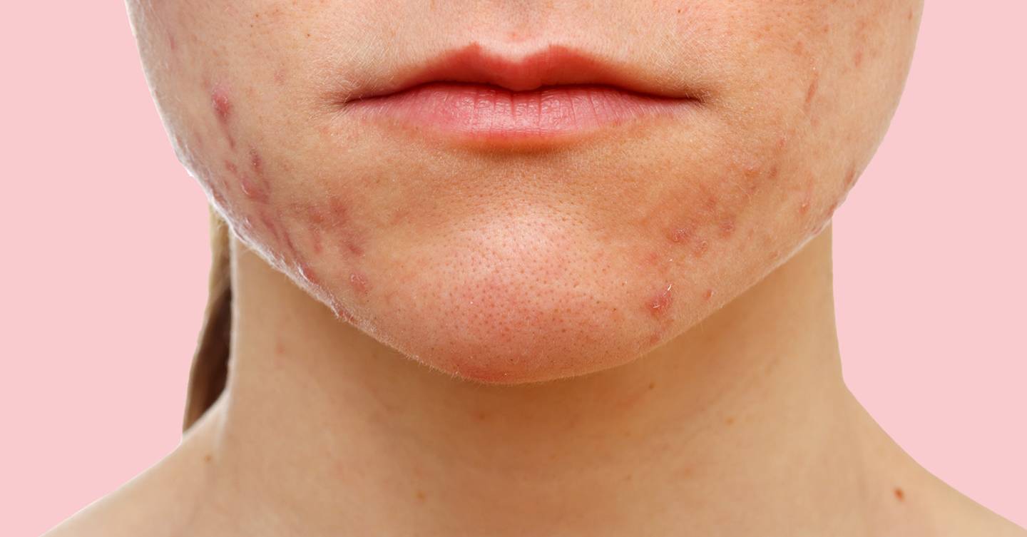 Teenager Cures Acne With Green Tea and Honey Glamour UK