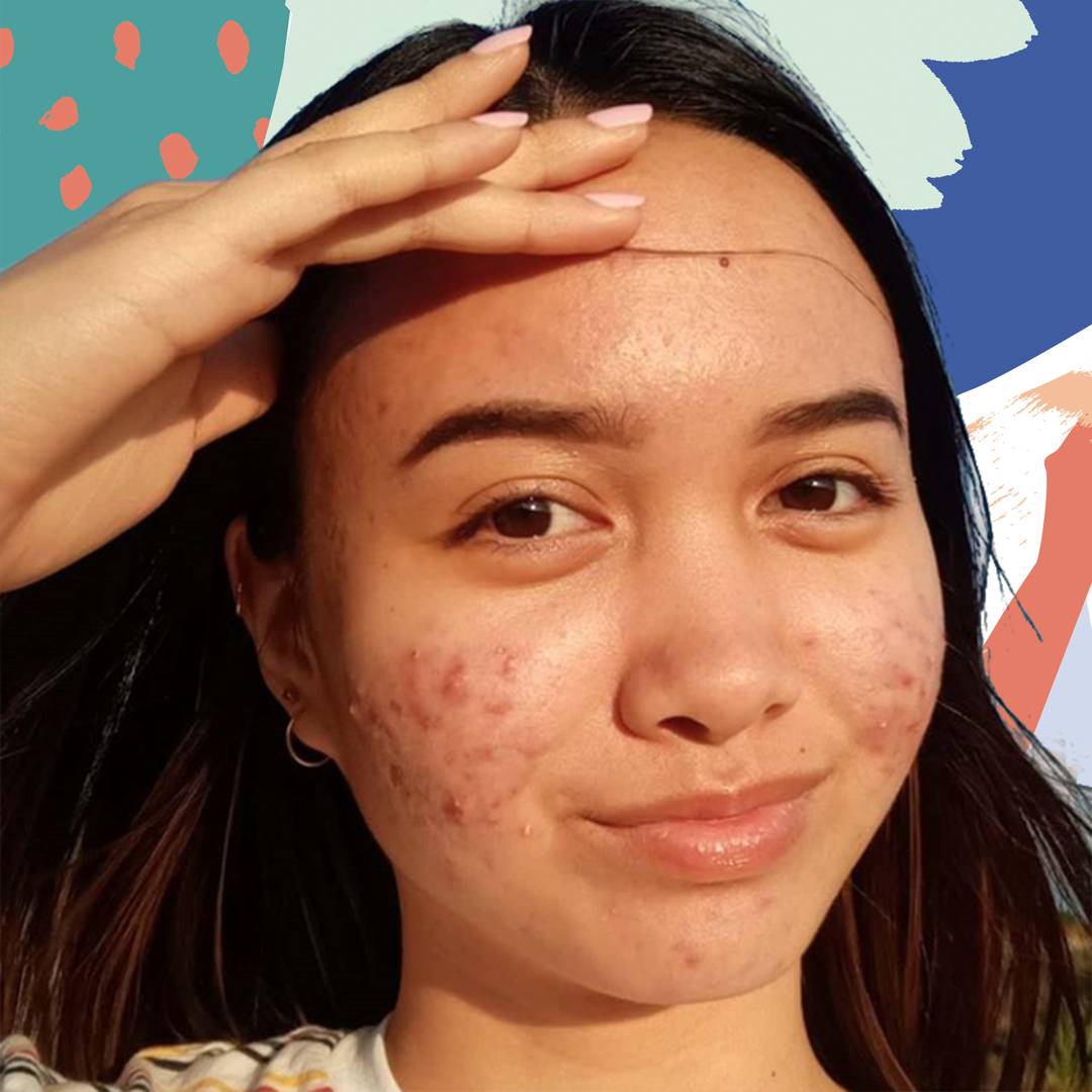 Image: 10 skin-positive influencers to follow for acne awareness month