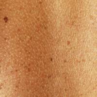 The Ultimate Guide To Checking Your Moles Knowing Your Body Glamour Uk