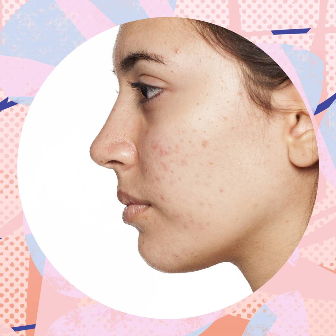 Image: Adult acne isnât just annoying - itâs holding women back at work