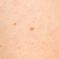 Chicken Skin How To Get Rid Of Those Pesky Bumps Glamour Uk