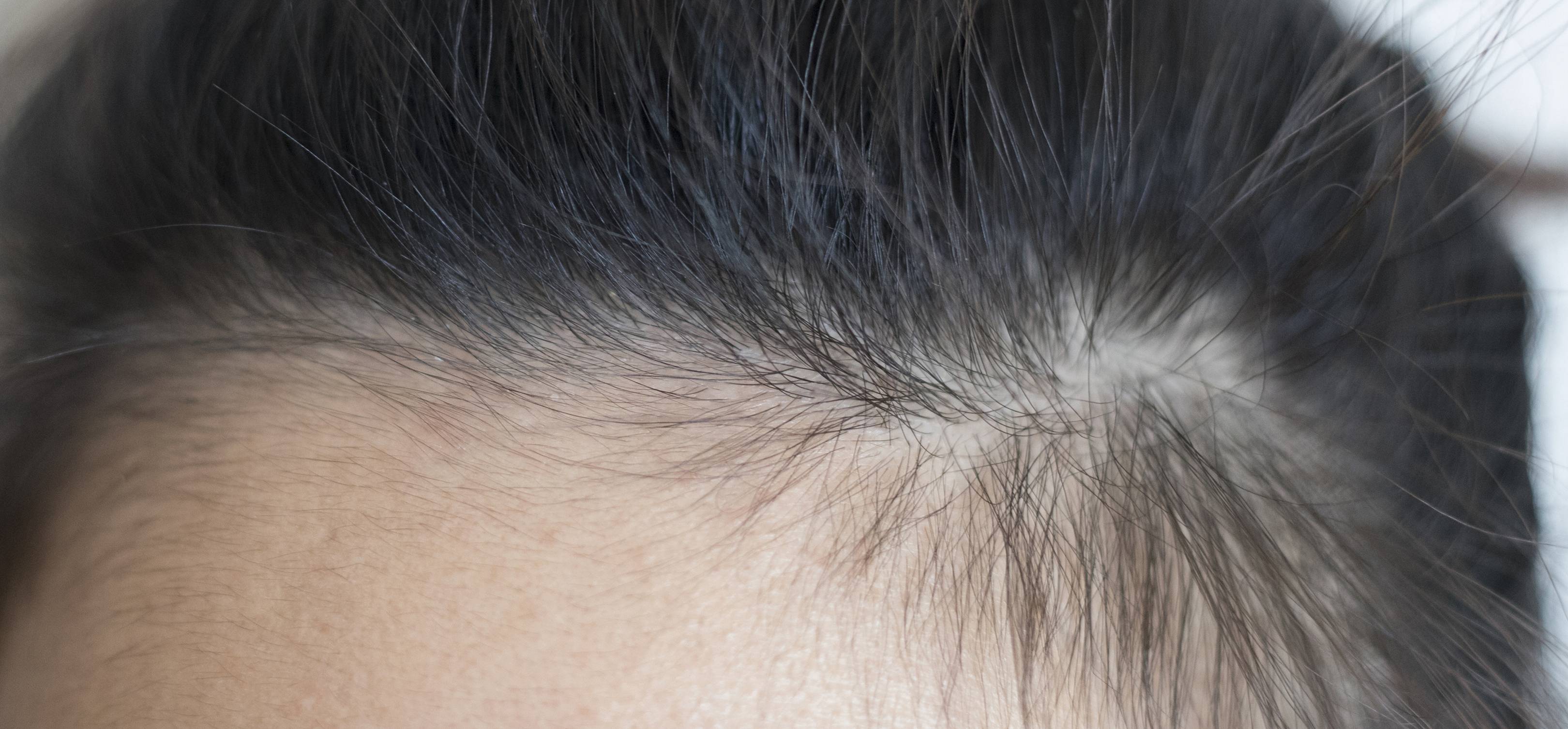 How To Treat Broken Hairs Along Your Hairline Glamour Uk