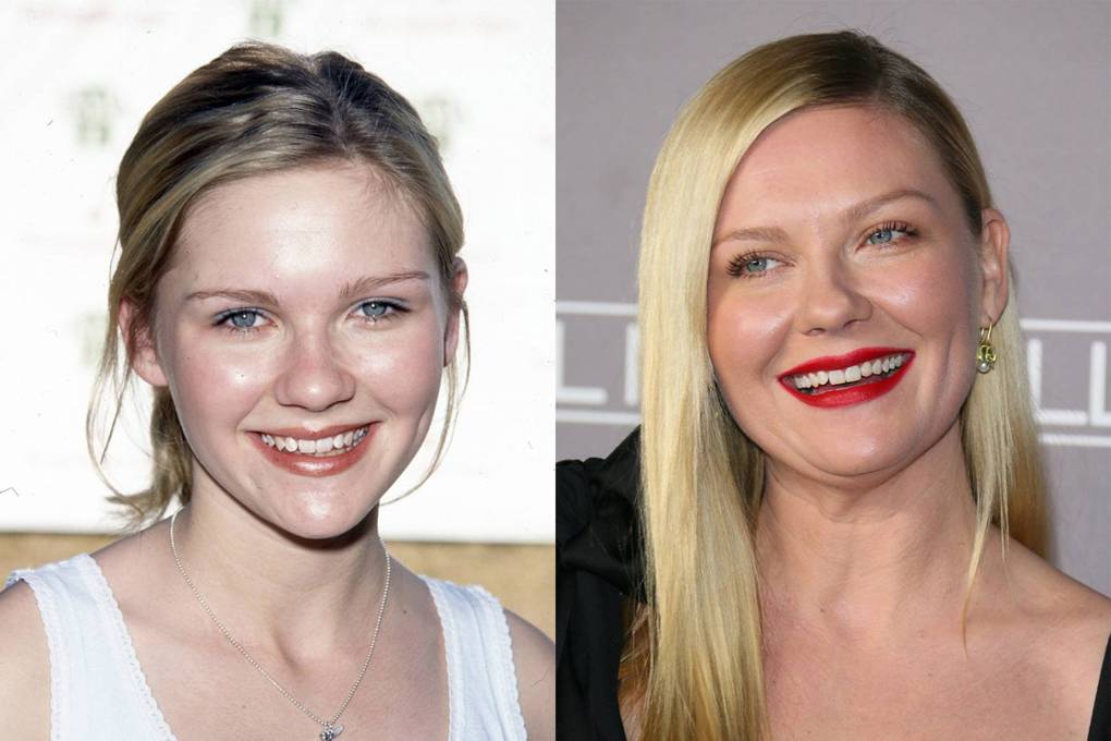 Celebrity Teeth Before & After: Dental Whitening Makeovers | Glamour UK