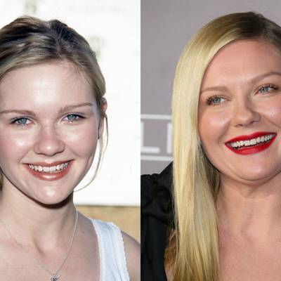 Celebrity Teeth Before & After: Dental Whitening Makeovers | Glamour UK