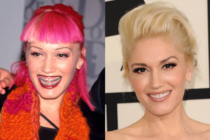 Celebrity Teeth Before & After: Dental Whitening Makeovers | Glamour UK