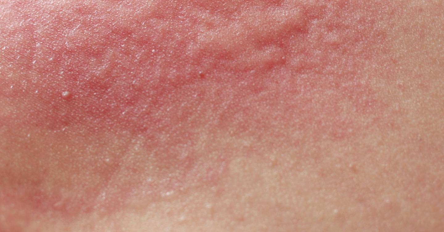 What Is Dermatitis? Causes, Treatments & Advice For Irritated Skin ...