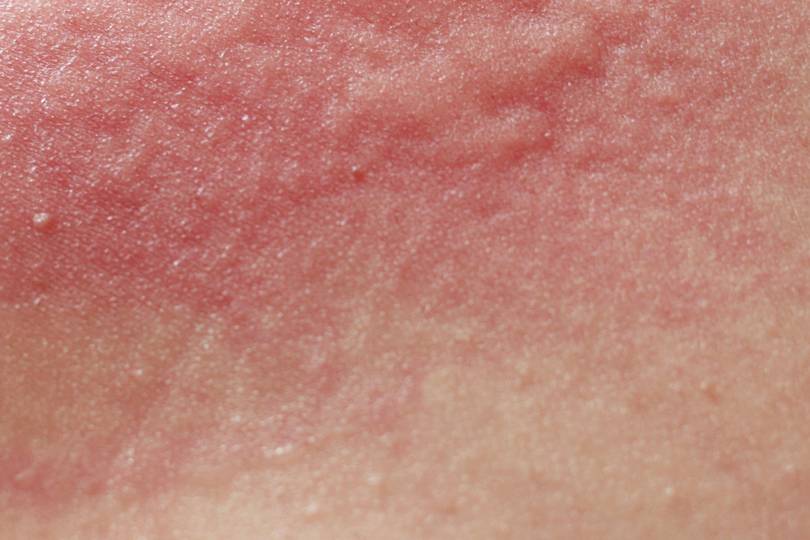 What Is Dermatitis? Causes, Treatments & Advice For Irritated Skin 