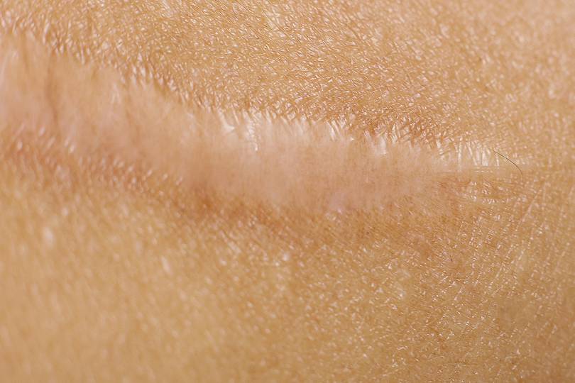 Keloid Scar Treatment Laser Treatment And Hypertrophic Scar Flattening