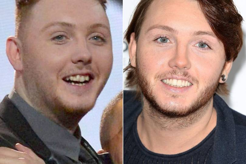 Celebrity Teeth Before & After: Teeth Whitening Makeovers ...