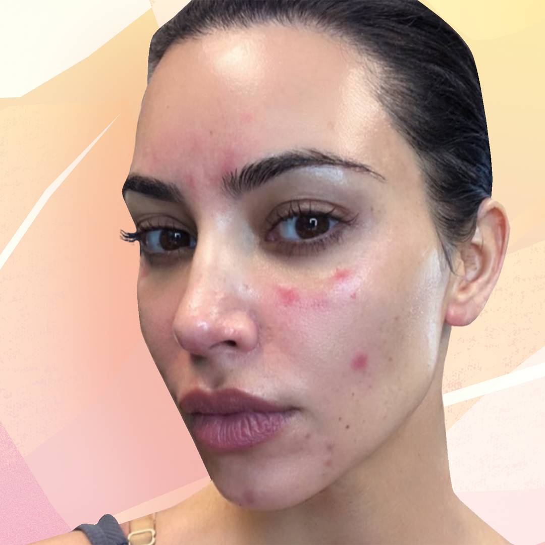 Image: Kim Kardashian just shared a candid photo of her psoriasis battle and it's so relatable