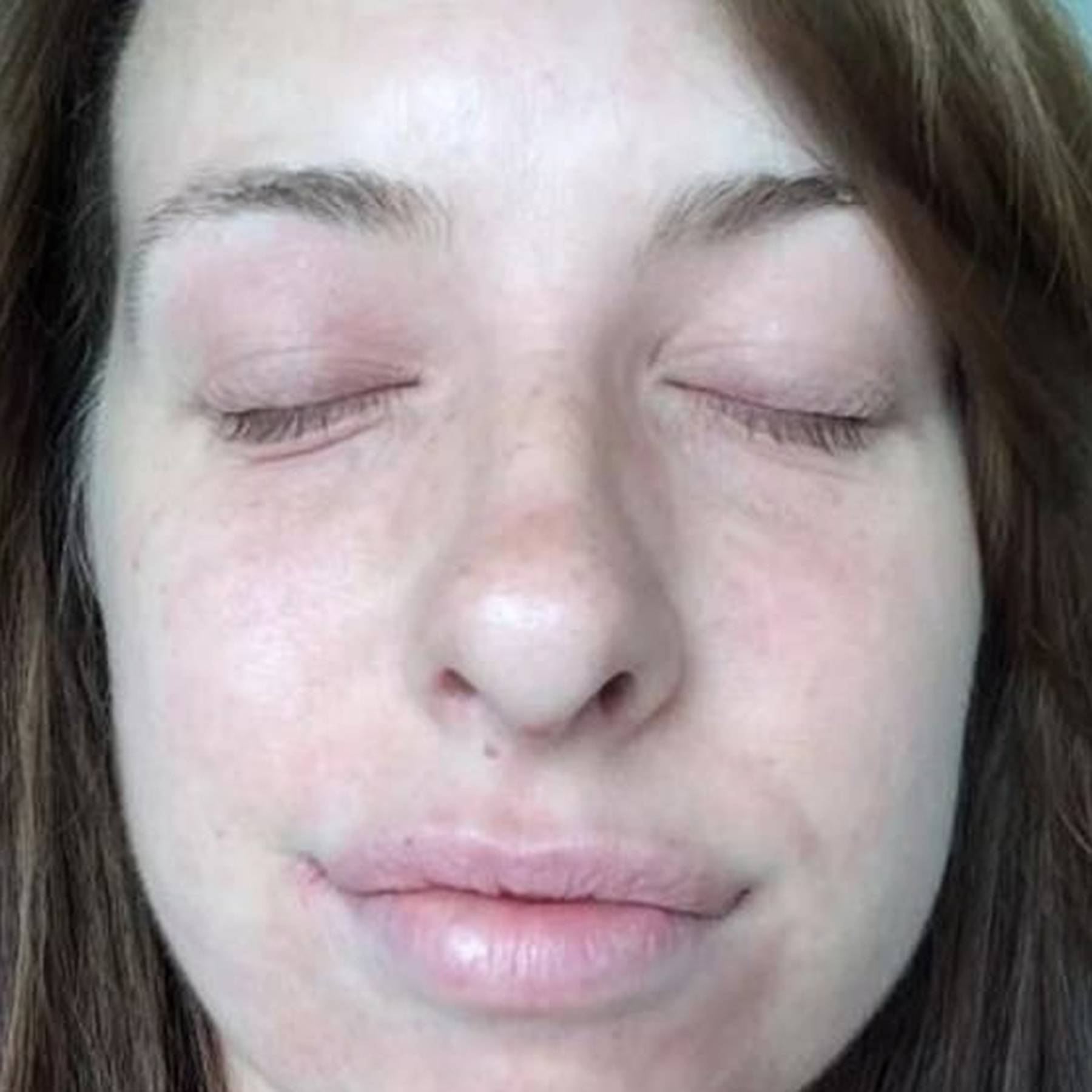 eczema glycolic acid